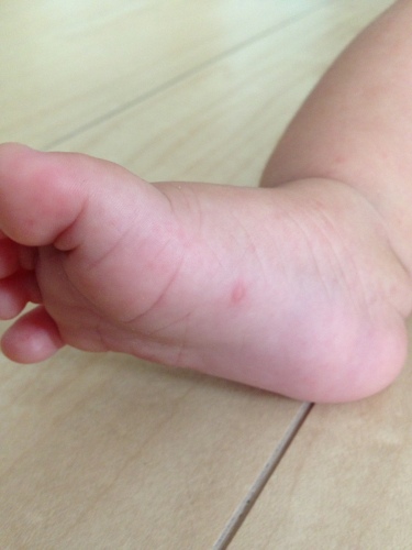 手足口病の経過 Hush Little Baby 保健師さんの育児ブログ 楽天ブログ