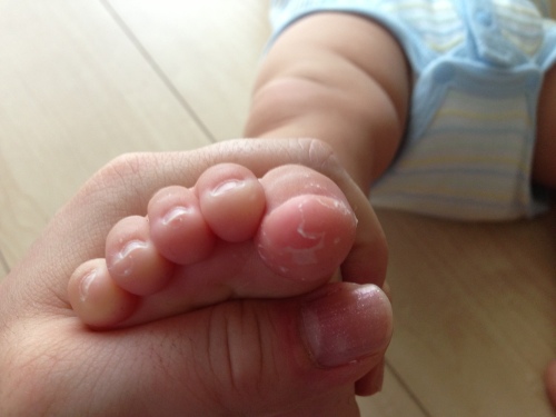 手足口病の経過 Hush Little Baby 保健師さんの育児ブログ 楽天ブログ