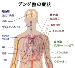 【R】14-09-04-6デング熱の症状２.jpg