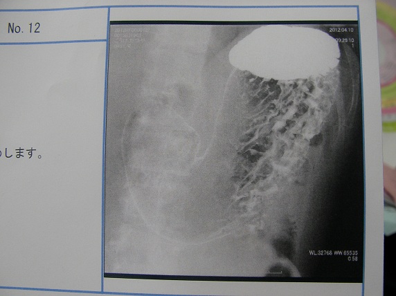 checkup stomach cancer.jpg