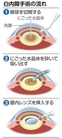 白内障の手術.jpg