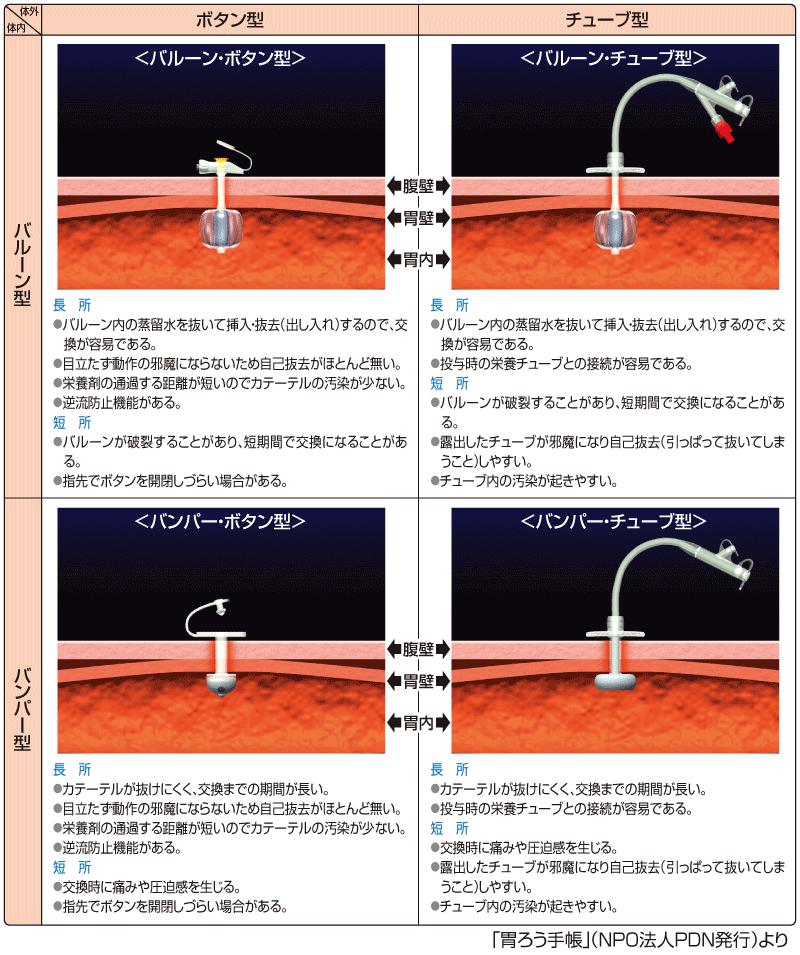 胃ろうの種類.JPG