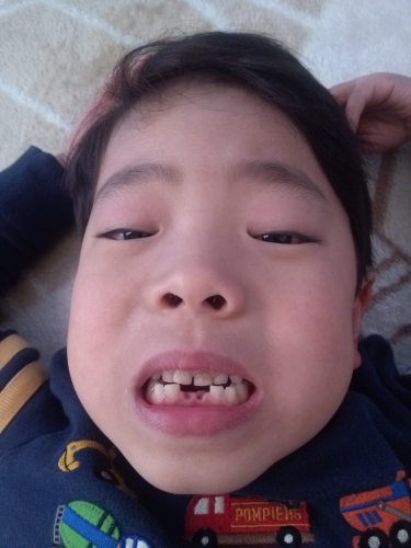 初めて歯が抜けました～(o^－^o)大人の歯が見えてきたので、歯医者さんで抜いてもらいました。歯がない叶翔(笑)